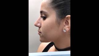 Correcting a hump and droopy tip by lengthening the nose