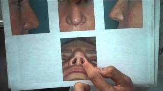 Plastic Surgery Miami: Revision Rhinoplasty Rib Graft – 1 Week Results