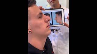 Rhinoplasty for an Overprojected Tip and Bridge in a Male Patient