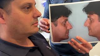 Rhinoplasty for asymmetric and crooked nose