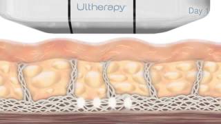 Ultherapy Miami – How the Ultherapy Treatment Works