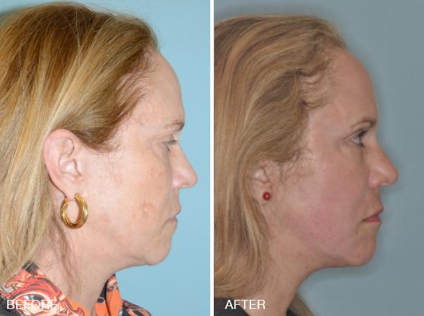 Blepharoplasty Photos | Miami, FL | Patient 1178