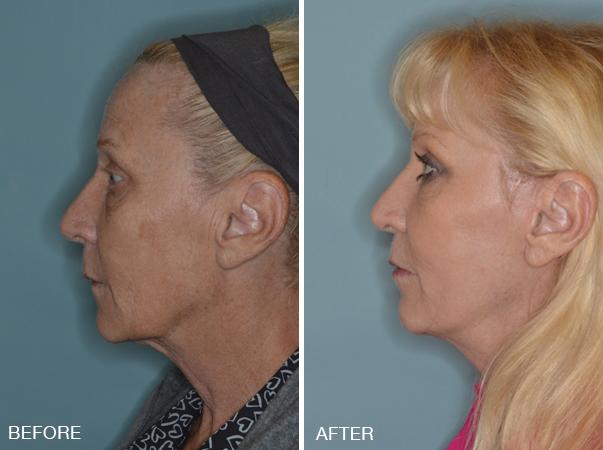 Blepharoplasty Before and After Photos in Miami, FL, Patient 1201