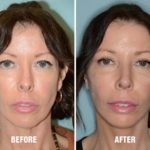 Blepharoplasty Before and After Photos in Miami, FL, Patient 1214