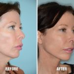 Blepharoplasty Before and After Photos in Miami, FL, Patient 1214