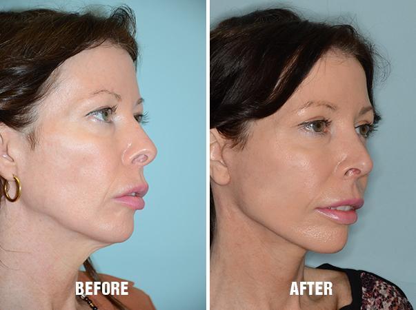 Blepharoplasty Before and After Photos in Miami, FL, Patient 1214