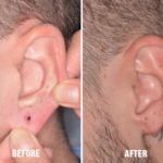 Earlobe Repair Before and After Photos in Miami, FL, Patient 1389