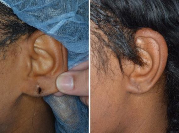 Earlobe Repair Before and After Photos in Miami, FL, Patient 1408