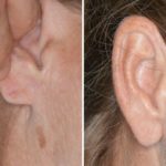 Earlobe Repair Before and After Photos in Miami, FL, Patient 1412