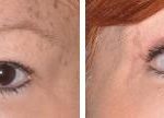 Blepharoplasty Before and After Photos in Miami, FL, Patient 1142
