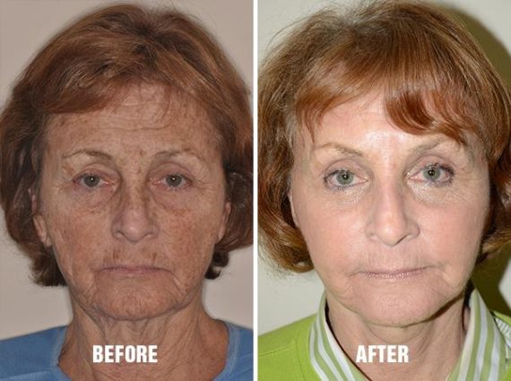 Blepharoplasty Before and After Photos in Miami, FL, Patient 1168