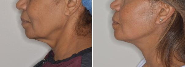 Facelift Before and After Photos in Miami, FL, Patient 1249