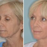 Facelift Before and After Photos in Miami, FL, Patient 1270