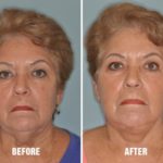 Facelift Before and After Photos in Miami, FL, Patient 1119
