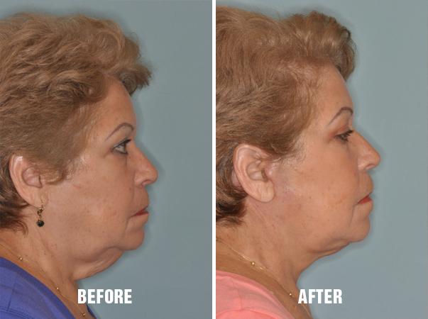 Facelift Before and After Photos in Miami, FL, Patient 1119
