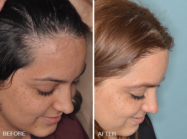 Hair Restoration Before and After Photos in Miami, FL, Patient 1578