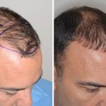 Hair Restoration Before and After Photos in Miami, FL, Patient 1623