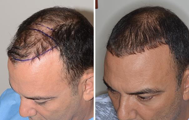 Hair Restoration Before and After Photos in Miami, FL, Patient 1623