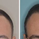 Hair Restoration Before and After Photos in Miami, FL, Patient 1633