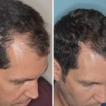 Hair Restoration Before and After Photos in Miami, FL, Patient 1641