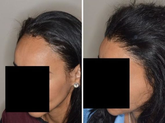 Hair Restoration Before and After Photos in Miami, FL, Patient 1672