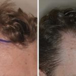 Hair Restoration Before and After Photos in Miami, FL, Patient 1589