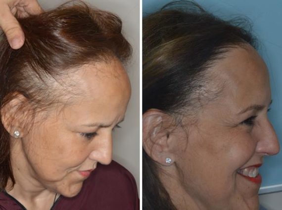 Hair Restoration Before and After Photos in Miami, FL, Patient 1713