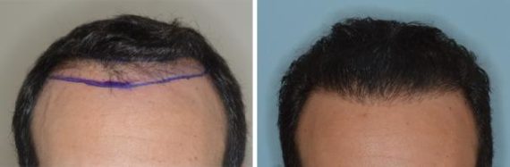 Hair Restoration Before and After Photos in Miami, FL, Patient 1722