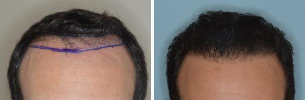 Hair Restoration Before and After Photos in Miami, FL, Patient 1722