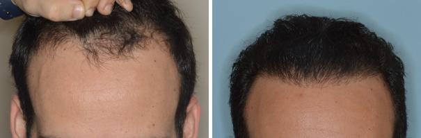 Hair Restoration Before and After Photos in Miami, FL, Patient 1722