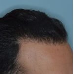 Hair Restoration Before and After Photos in Miami, FL, Patient 1722