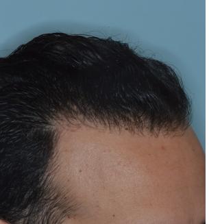 Hair Restoration Before and After Photos in Miami, FL, Patient 1722