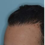 Hair Restoration Before and After Photos in Miami, FL, Patient 1722