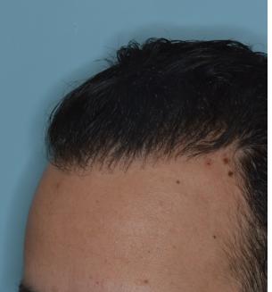 Hair Restoration Before and After Photos in Miami, FL, Patient 1722