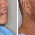 Hair Restoration Before and After Photos in Miami, FL, Patient 1767