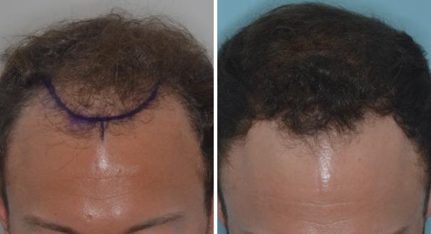 Hair Restoration Before and After Photos in Miami, FL, Patient 1781