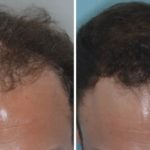 Hair Restoration Before and After Photos in Miami, FL, Patient 1781