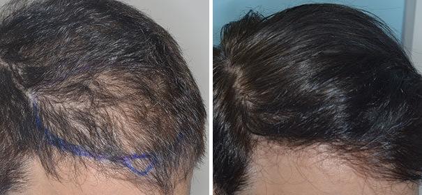 Hair Restoration Before and After Photos in Miami, FL, Patient 1788