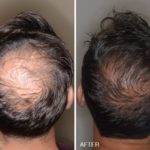 Hair Restoration Before and After Photos in Miami, FL, Patient 1610