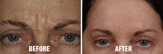 Injectables Before and After Photos in Miami, FL, Patient 1538