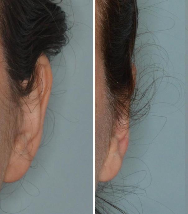 Otoplasty Before and After Photos in Miami, FL, Patient 1322
