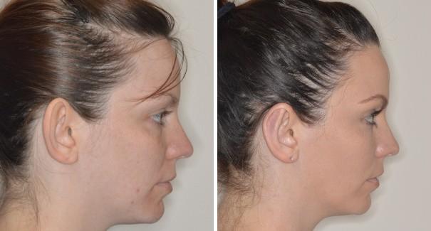 Otoplasty Before and After Photos in Miami, FL, Patient 1347