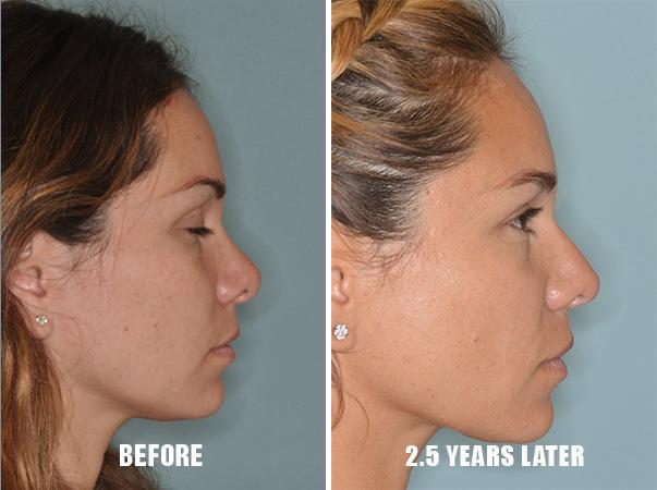 Revision Rhinoplasty Before and After Photos in Miami, FL, Patient 792