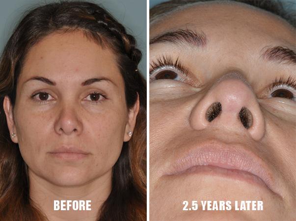 Revision Rhinoplasty Before and After Photos in Miami, FL, Patient 792