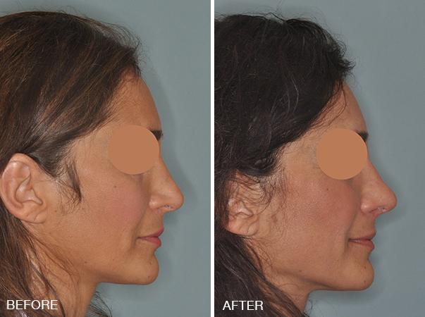 Revision Rhinoplasty Before and After Photos in Miami, FL, Patient 827