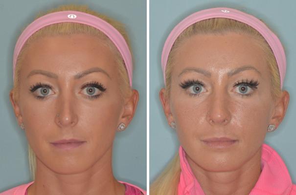 Revision Rhinoplasty Before and After Photos in Miami, FL, Patient 934