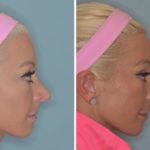 Revision Rhinoplasty Before and After Photos in Miami, FL, Patient 934