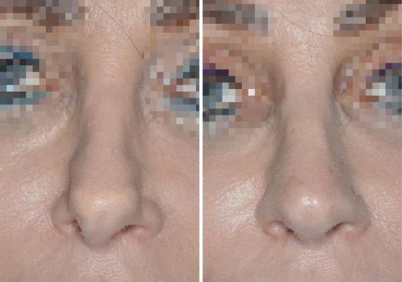 Revision Rhinoplasty Before and After Photos in Miami, FL, Patient 970