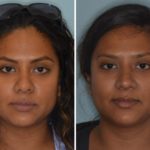 Revision Rhinoplasty Before and After Photos in Miami, FL, Patient 980