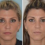 Revision Rhinoplasty Before and After Photos in Miami, FL, Patient 987